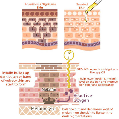 GFOUK™ Acanthosis Nigricans Therapy Oil ✨ Approved by American Academy of Dermatology